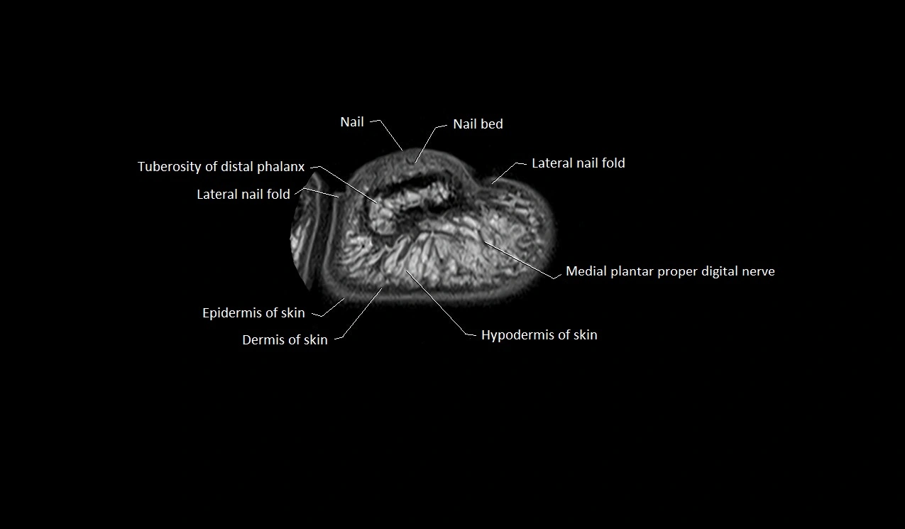 Great toe (hallux) axial microanatomy 3T MRI image 5.webp